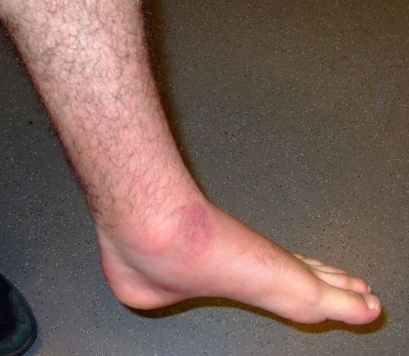 Soubor:Viper bite.jpg