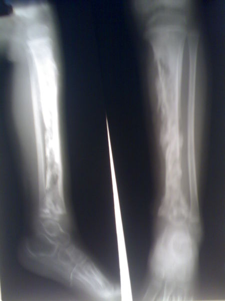 Soubor:Ostermyelitis Tibia.jpg